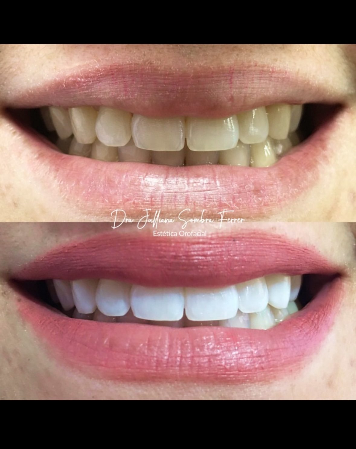 Clareamento Dental