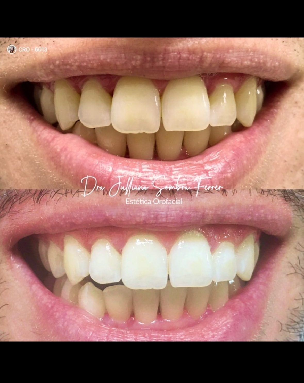 Clareamento Dental