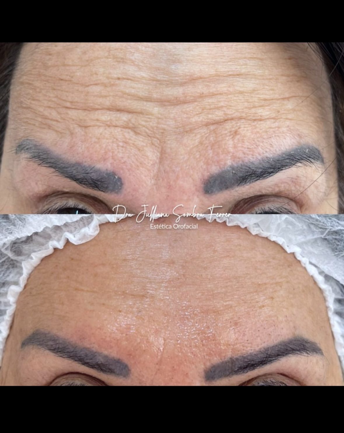 Toxina Botulínica — Testa