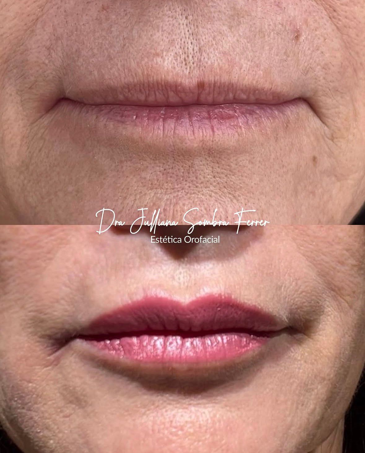 Preenchimento Labial — Antes e Depois